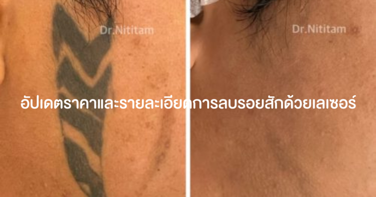 การลบรอยสักด้วยเลเซอร์